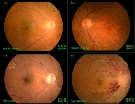 Chụp đáy mắt màu giúp bác sĩ đánh giá được tình trạng mắt
