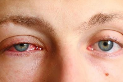 Mắt đỏ có thể là triệu chứng của viêm màng bồ đào