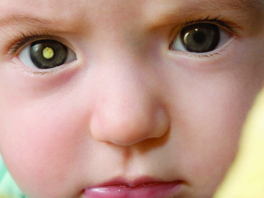 Đục thuỷ tinh thể có thể xuất hiện ở trẻ nhỏ